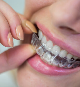 Meine Meinung zu Invisalign-Schienen Schlechter oder besser als feste Zahnspangen