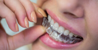Meine Meinung zu Invisalign-Schienen Schlechter oder besser als feste Zahnspangen