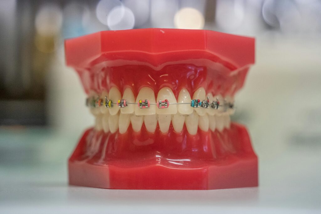 feste Zahnspange (Brackets)